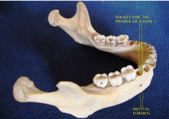 Gambar 3 . Panoramik radiografi menunjukkan variasi dari posisi foramen mentale dalam bidang vertikal dalam hubungannya dengan apeks  premolar.4 