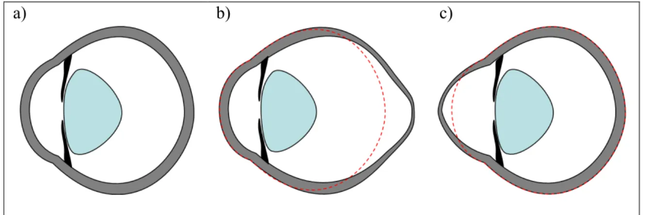 Figure 1.1. a) A normal eye. Thinning and stretching in the b) posterior sclera in  degenerative myopia and c) cornea in keratoconus