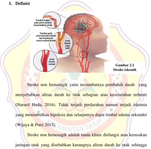 Gambar 2.1  Stroke iskemik 