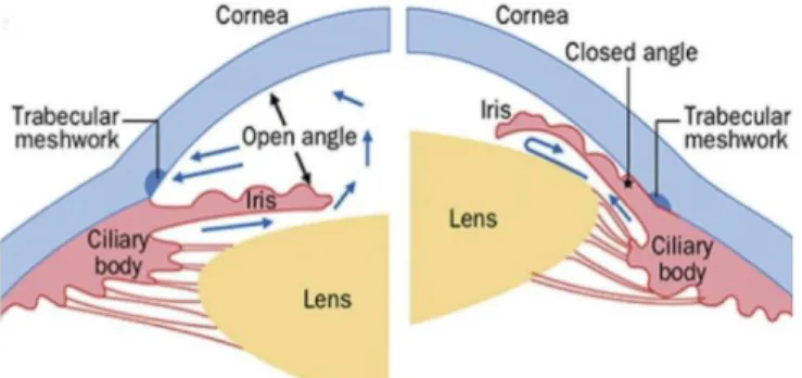 Figure 2.1.1 Illustration of two main types of glaucoma; open angle glaucoma (left) and closed angle  glaucoma (right)