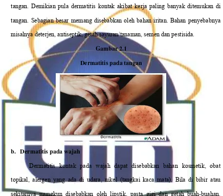 Gambar 2.1 Dermatitis pada tangan 