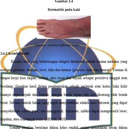 Gambar 2.4 Dermatitis pada kaki 
