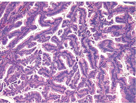 Gambar. 2.3.4. Mikroskopis Mucinous Carcinoma. Dikutip dari : text book of Gynecologic Pathology, 2008  