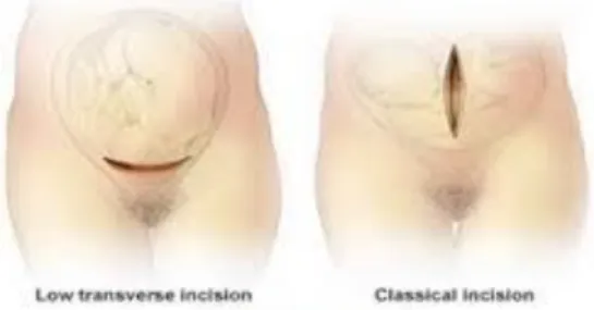 Gambar 2.2 jenis-jenis sayatan ( https://www.sc+abdominalis&amp;profundal) 