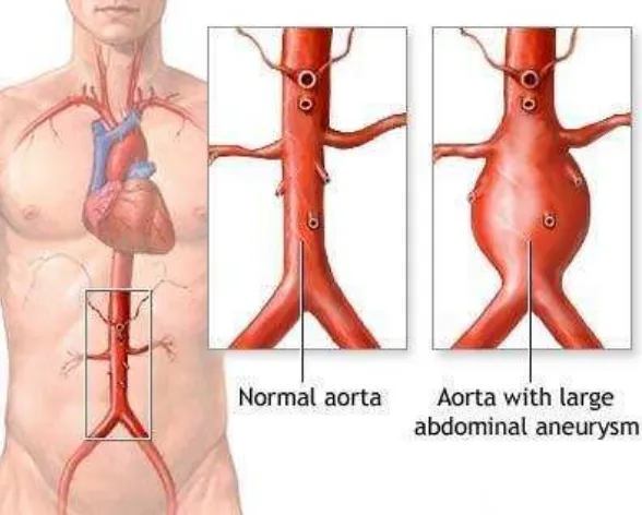 Gambar 2. Plak pada lapisan endotel dari arteri 