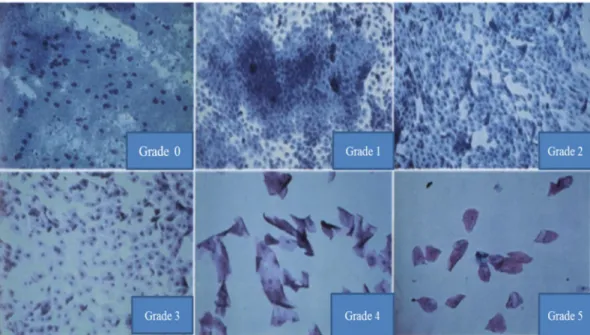 Gambar 2.8    Gambaran sitologi metaplasia skuamosa grade 0-5  Dikutip dari : Tseng 25