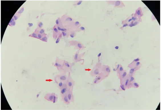 Gambar 1.    Derajat 0 metaplasia konjungtiva pada baseline terapi ACE inh/ARB  Keterangan : Gambaran sel goblet (tanda panah merah), sel epitel  