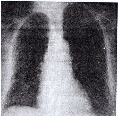 Gambar 2.5  metastasis kanker usus. PA radiografi  memperlihatkan gambaran 