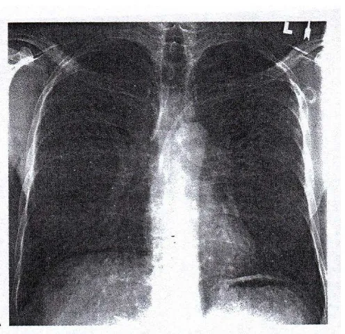 Gambar 2.7  tonsilar squamous cell carcinoma metastases. PA radiografi pria 