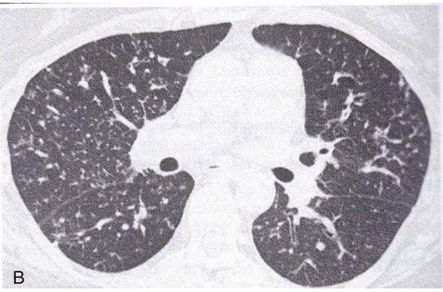 Gambar 2.11 metastasis kanker usus. CT scan memperlihatkan banyak nodul 