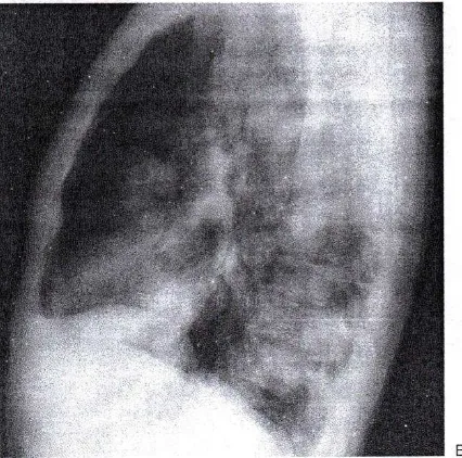 Gambar 2.13  metastasis kanker testis. radiografi memperlihatkan numerous 