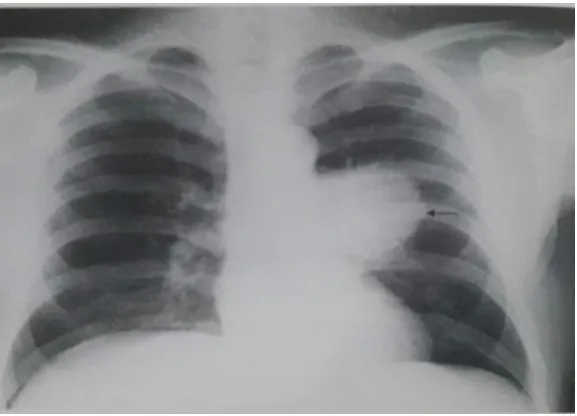 Gambar 2.6. Hamartoma 