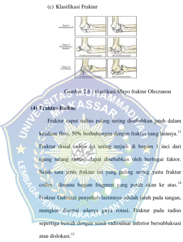 Gambar 2.6 : klasiikasi Mayo fraktur Olecranon  (4) Fraktus Radius 
