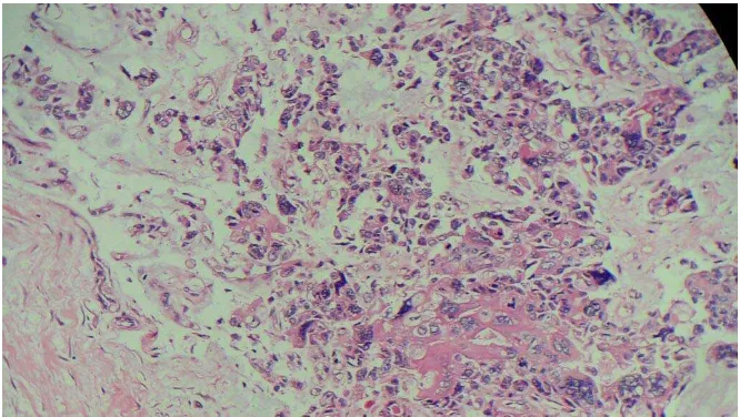 Gambar 8.Gambaran Histopatologi Kanker Payudara Duktal Invasif Grade I. 