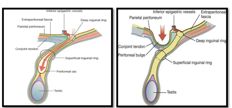 GAMBAR 2.2. : INDIRECT INGUINAL DAN DIRECT INGUINAL HERNIAS 14 
