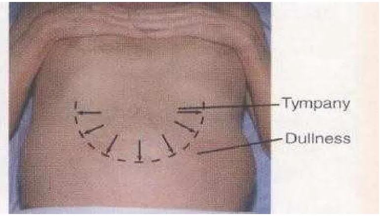 Gambar 14     Test  Shifting  dulness 