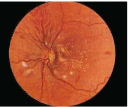 Gambar 2.1 Klasifikasi retinopati hipertensi: stadium 1,  stadium 2, stadium 3, stadium4