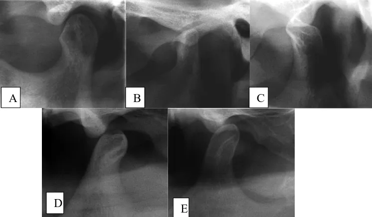 Gambar 9. A. Flattening, B. Osteofit, C. DJD, D. Erosi, E.Sklerosis 