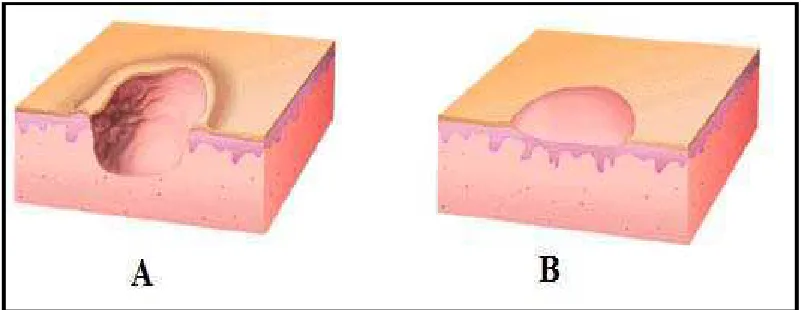 Gambar 1 A. Ulser. B. Erosi14 
