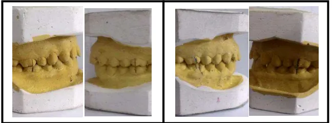 Gambar 8. Klasifikasi molar simetris (kiri) dan asimetris (kanan)