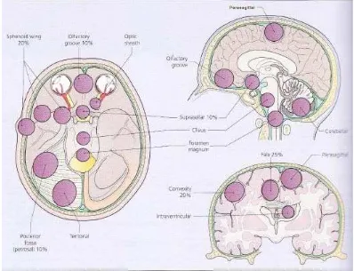 Gambar 2,1. Variasi lokasi timbulnya meningioma (Al-Mefty, 2005) 