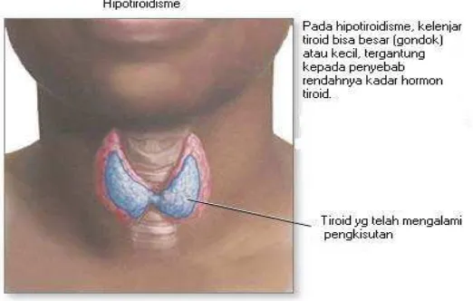 Gambar 2.2   Hipotiroidisme 5 