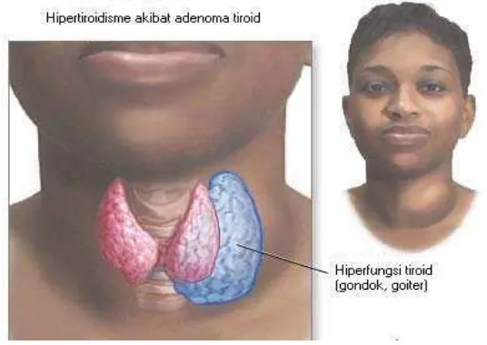 Gambar 2.3.  Hipertiroidisme 5 
