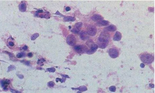 Gambar 5. Kelompokan sel-sel epitel undifferentiated,dengan latar belakang limfosit. Tampak sitoplasma   yang eosinofilik dan anak inti yang prominen (Dikutip dari: Orell, SR, Philips, J