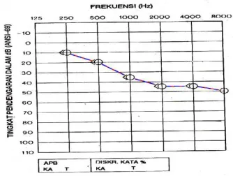 Gambar 2.7.  Gambaran audiometri tuli sensorineural 