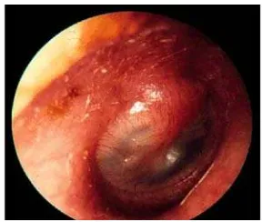 Gambar 2.6. Membran Timpani Hiperemis  