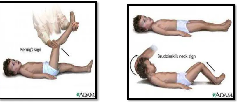 Gambar 2.3. Pemeriksaan tanda Kernig  Gambar 2.4. Pemeriksaan Tanda  