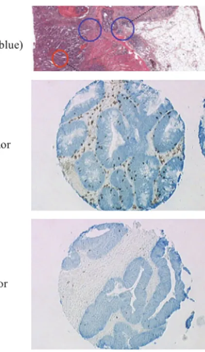 Fig. 1 Characterization of immune infiltrates in colon cancer: The center (red circle) and the invasive margin (blue circle) of colon tumor (Hematoxylin and eosin staining, original magnification 40  ) (a), Tumors with high (b) or low (c) densities of CD8+