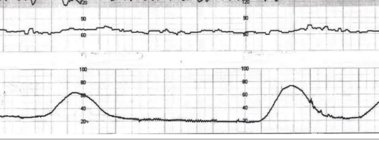 Figure 3.3       Case example. Fetal heart rate and uterine activity following interventions