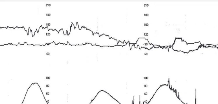 Figure 3.4       Case example. Adverse fetal heart rate changes during labor.  