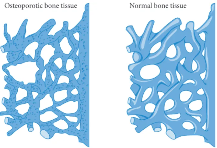 Figure 3.1  Osteoporotic and normal bone structures. Notice  how much mass the osteoporotic bone has lost.