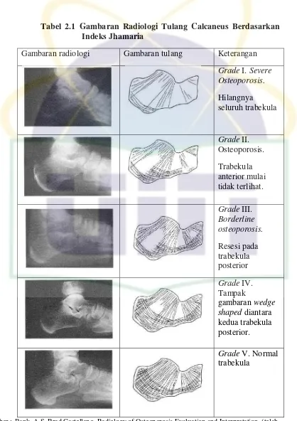 Tabel 2.1 Gambaran Radiologi Tulang Calcaneus Berdasarkan 