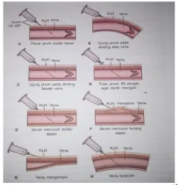 Gambar 2.5 Posisi Penusukan Jarum (13)