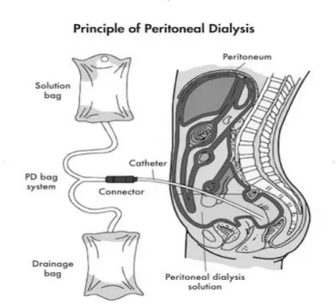 Gambar 3. Prinsip prosedur  dialisis peritoneal  Sumber: h  p://www.fmc-ag.cl/