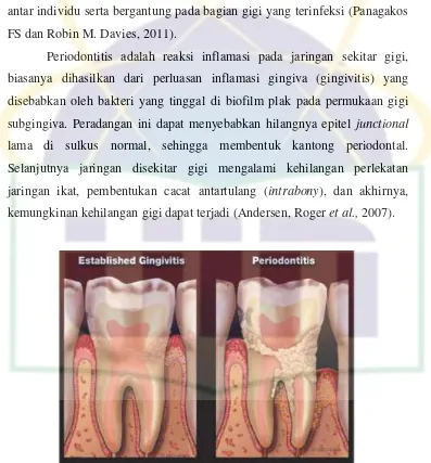 Gambar 2.1. Keadaan Gingivitis dan Periodontitis  