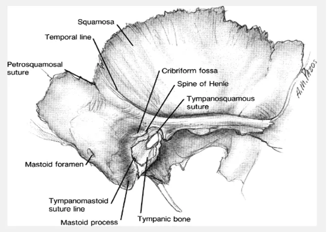 Gambar 2.3. Spina supra meatum Henle merupakan bagian penting pada regio temporal (Meyer, Strunk & Lambert 2006)