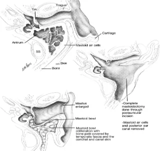 Gambar 2.4. Radical mastoidectomy, SS, sigmoid sinus; Tm, tympanic membrane, dilakukan pembersihan total sel-sel mastoid dan dinding posterior liang telinga diruntuhkan (Meyer, Strunk & Lambert 2006)