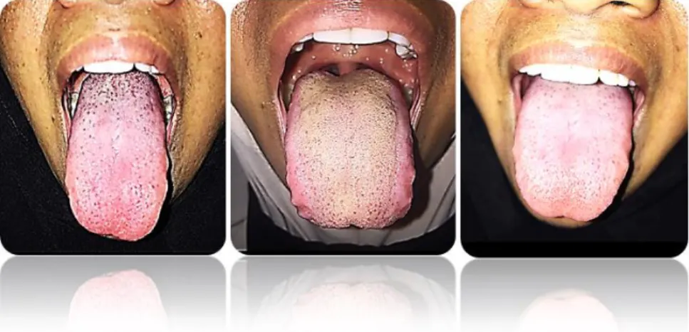 Gambar 4. Coated Tongue 