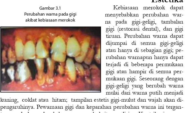 Gambar 3.1EstetikaPerubahan warna pada gigi Kebiasaan merokok dapat kuning,  coklat atau  hitam;  tampilan estetis gigi-mulut dan wajah akan di-pengaruhinya