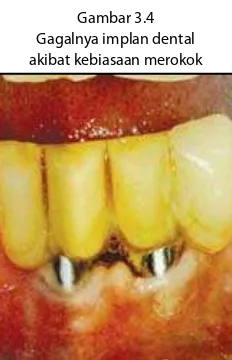 Gambar 3.4Beberapa studi telah mengindikasikan pe-ngaruh buruk dari kebiasaan merokok terha-Gagalnya implan dental 