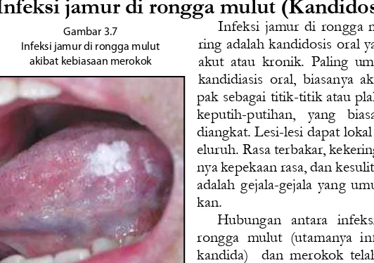 Gambar 3.7Infeksi jamur di rongga mulut terse-Infeksi jamur di rongga mulutring adalah kandidosis oral yang sifatnya 