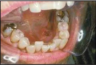 Gambar 3.8Prakanker mulutDi rongga mulut dapat ditemu-mulut di tempat dimana tembakau tersebut sering diletakan, tetapi beberapa pe-rubahan tersebut kelihatannya dapat membaik bila kebiasaan dihentikan.kan leukoplakia di tepi lateral lidah lebih sering ter