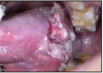 Gambar 3.9Mayoritas kanker mulut, yang Kanker mulut akibat kebiasaan merokokmerupakan 2-3% dari jumlah ke-