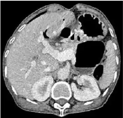 Gambar 3.4. CT scan pada pasien post prsedur Kasai
