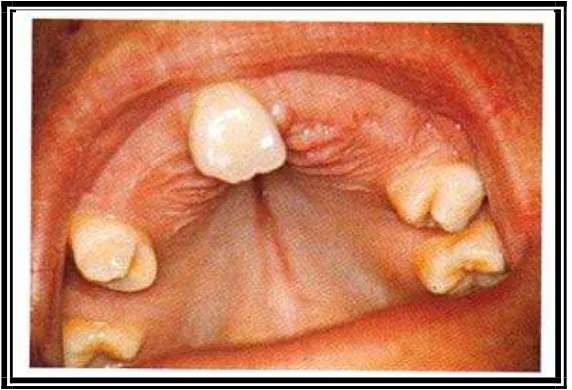 Gambar 2. Palatum yang tinggi dan beberapa gigi permanen tidak erupsi pada penderita Kleidokranial displasia (Laskaris George