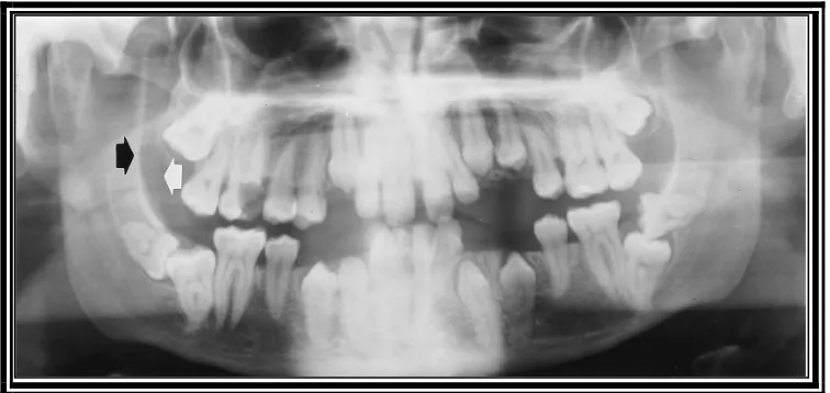 Gambar 3 Radiografi panoramik pada penderita Kleidokranial displasia usia 12 tahun memperlihatkan gigi desidui yang persistensi